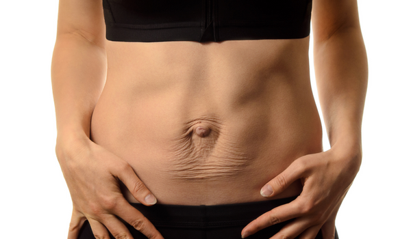 what is diastasis recti?